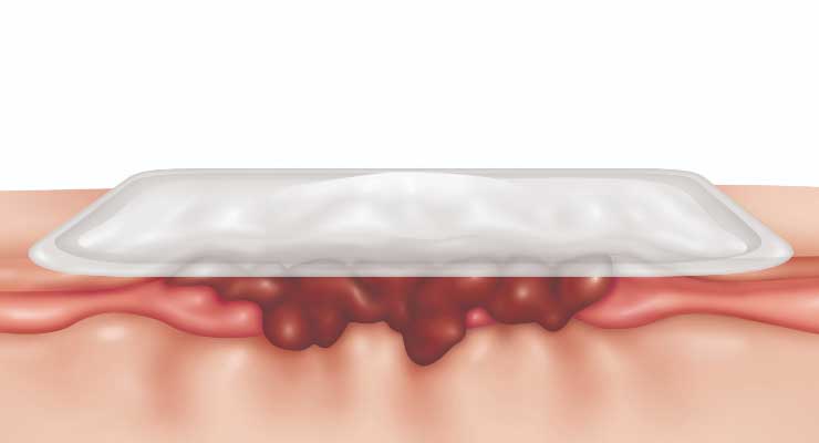 Role of Collagen in Wound Care